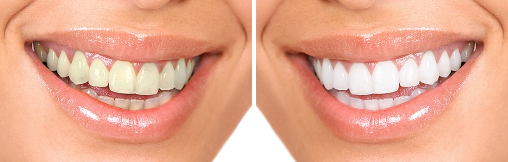 Diş Beyazlatma Yöntemleri