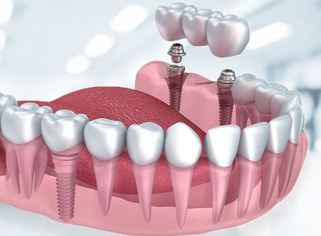 İmplant Diş Fiyatları