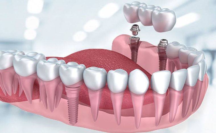 İmplant Diş Fiyatları