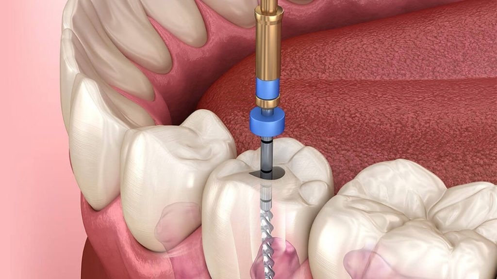 Antakya Kanal Tedavisi