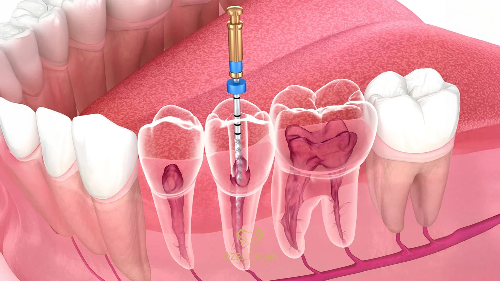 Kanal tedavisi nasıl yapılır