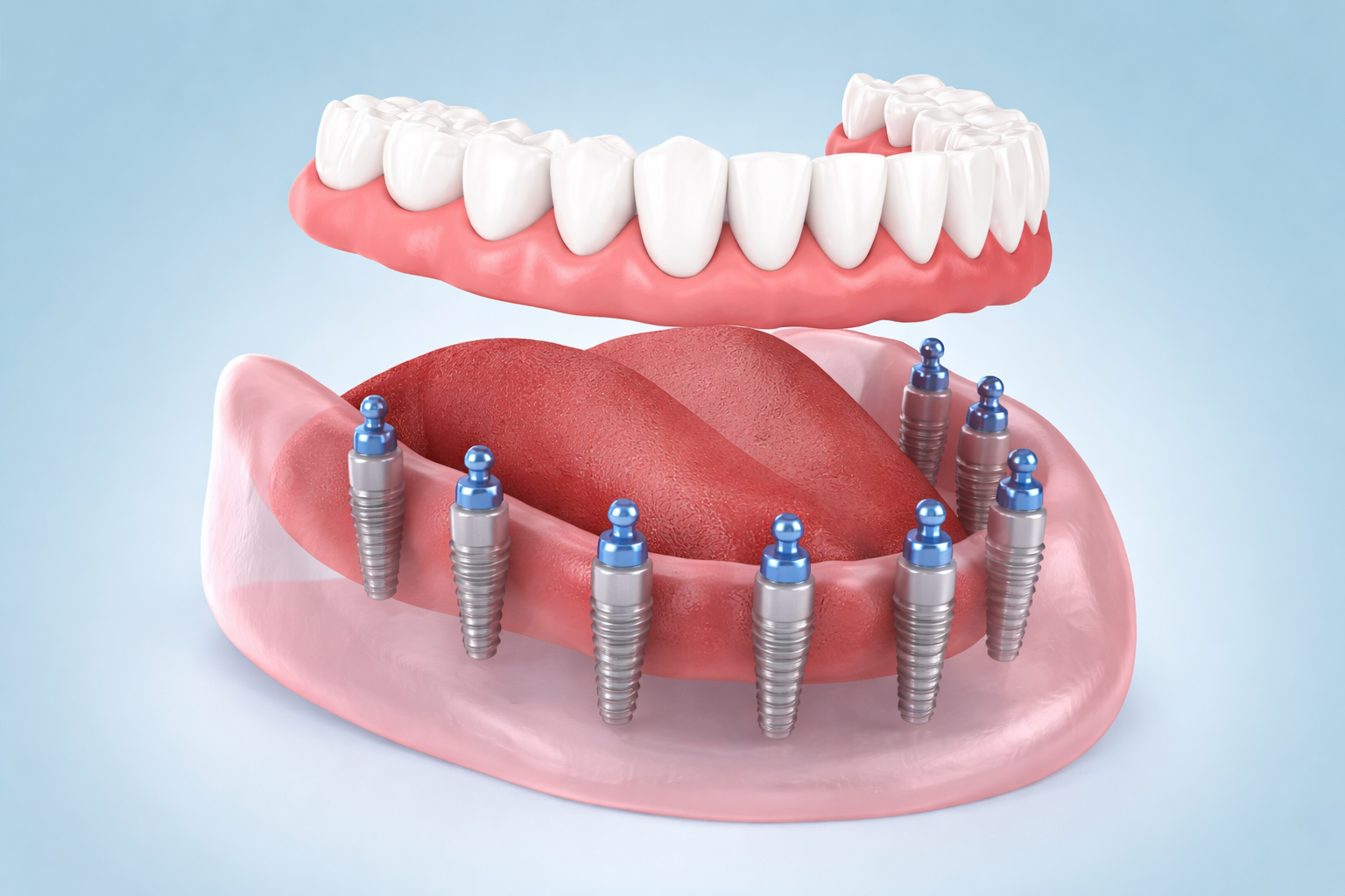 İmplant Diş Nasıl Yapılır